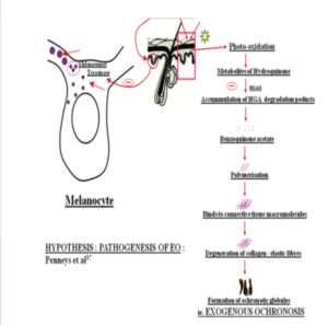 Ochronosis