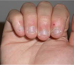 Nail infections