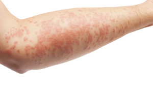 Eczema