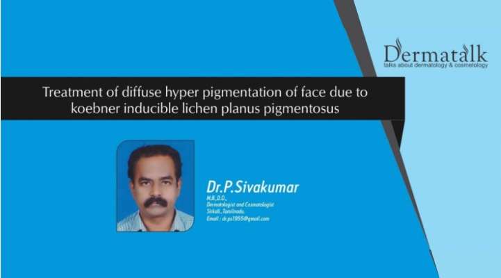 Treatment Of Diffuse Hyper Pigmentation Of Face Due To Koebner Inducible Lichen Planus Pigmentosus