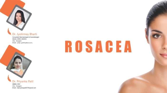 Rosacea