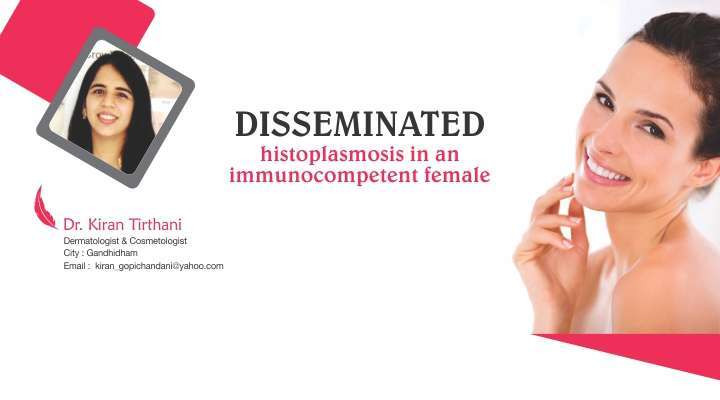DISSEMINATED Histoplasmosis in an Immunocompetent Female