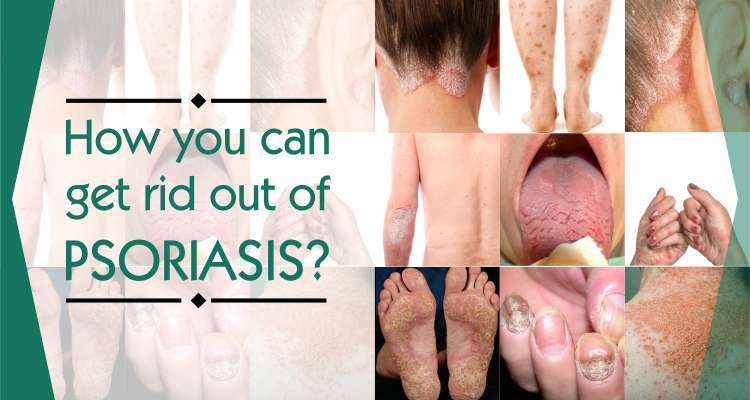 How you can get rid out of psoriasis?