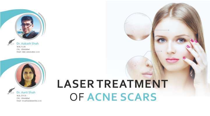 Laser Treatment of Acne Scars