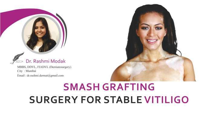 Smash Grafting Surgery for Stable Vitiligo