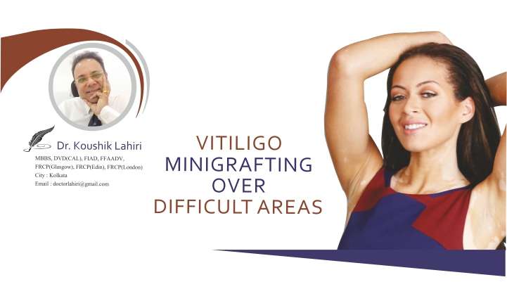 Vitiligo Minigrafting over Difficult Areas