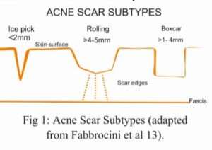 acne scaring 2