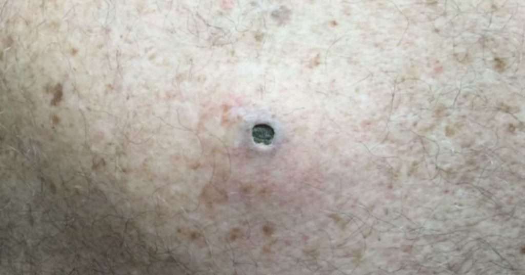 big blackhead