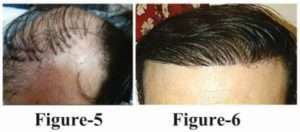 hair transplant 5