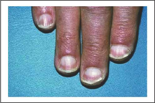 half and half nails - Ethicare Remedies